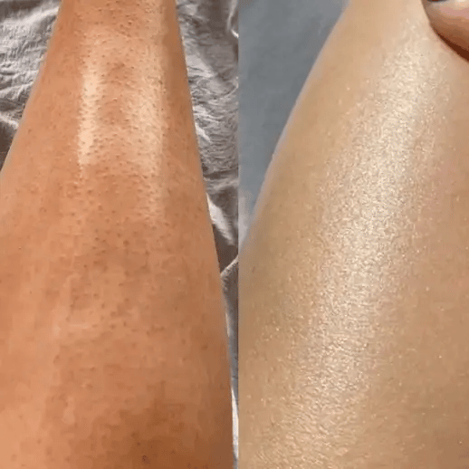 Depiladora Yes® Tecnología delicada para una piel perfecta